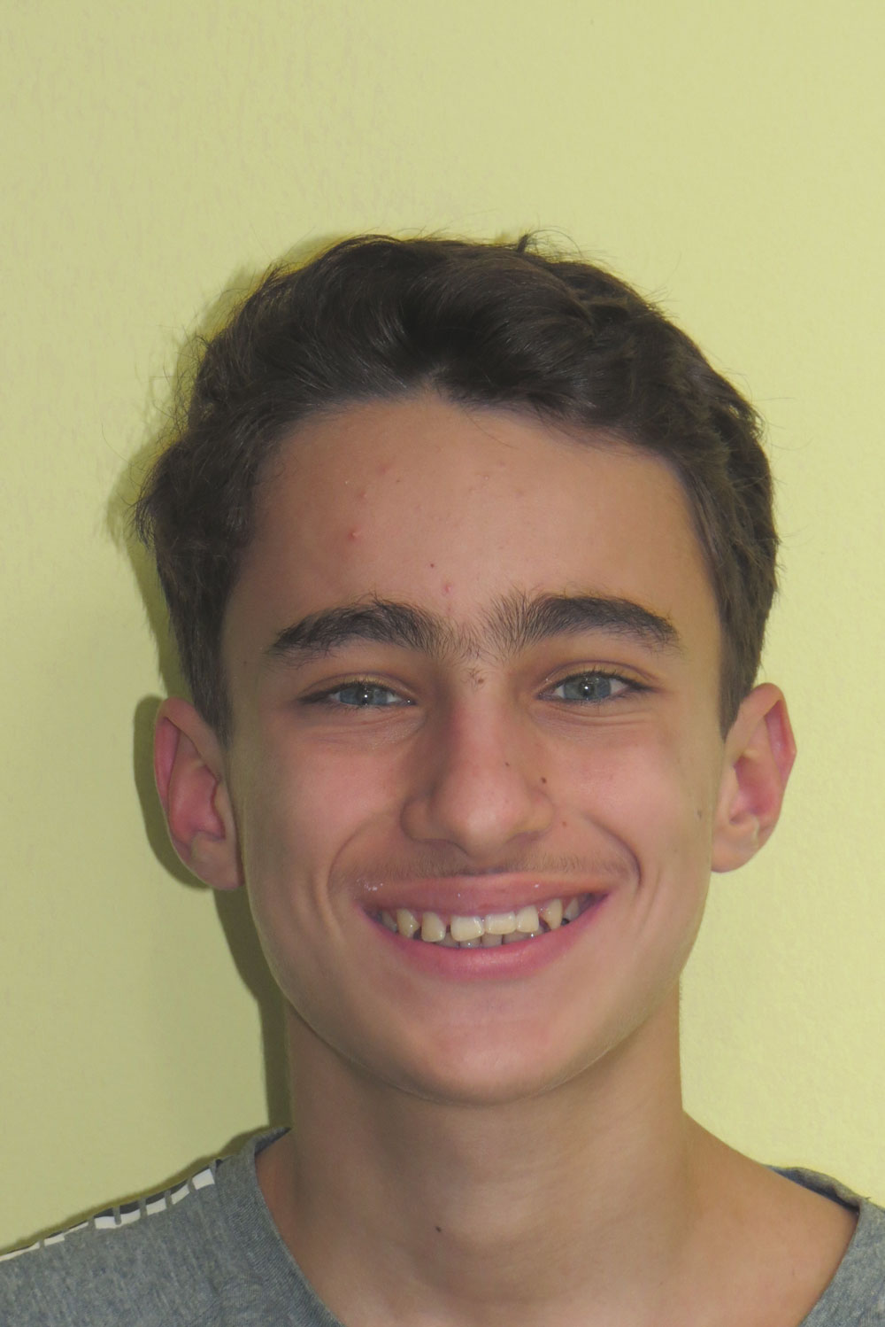 Allineatori trasparenti. Dopo il trattamento